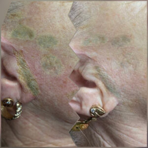 pigmentfolt-halványítás