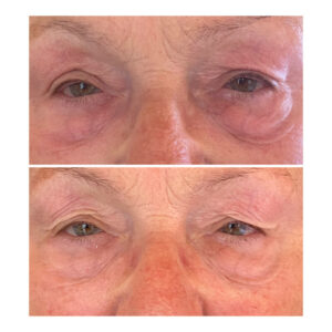 termikus-ionizáció