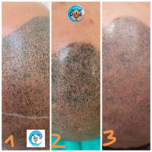 tetoválás_eltávolítás